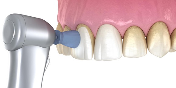 PMTC（歯のクリーニング） 審美歯科治療