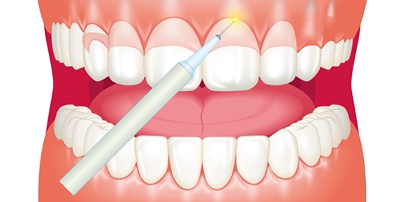 歯肉整形 ガミースマイル治療