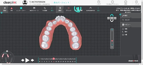 3Dソフトによる治療経過の視覚化　クリアコレクト