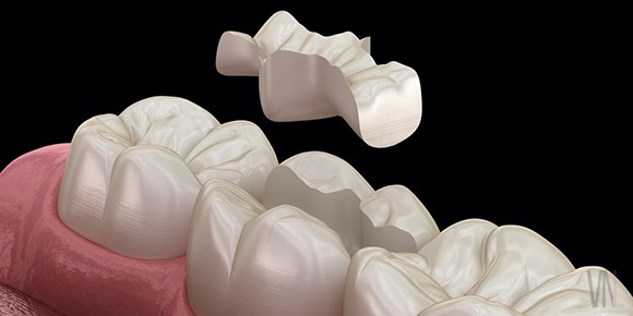 セラミックインレー　歯の修復