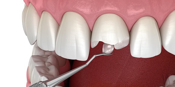 ダイレクトボンディング　歯の修復