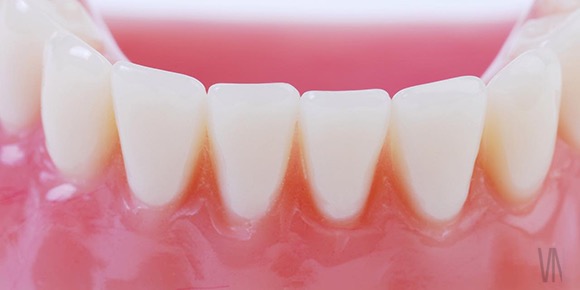 ガムピーリング　歯茎の変色(治療)