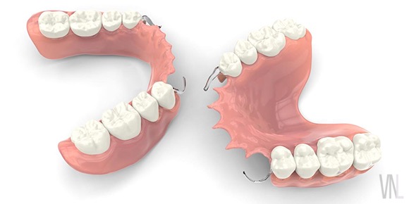 入れ歯　歯の欠損 (治療)