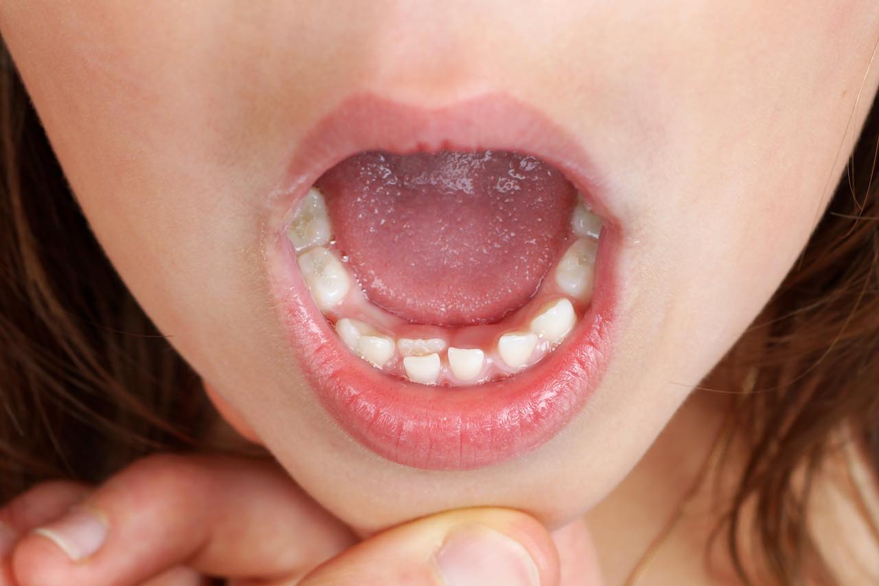 転位歯とは？その原因と治療法
