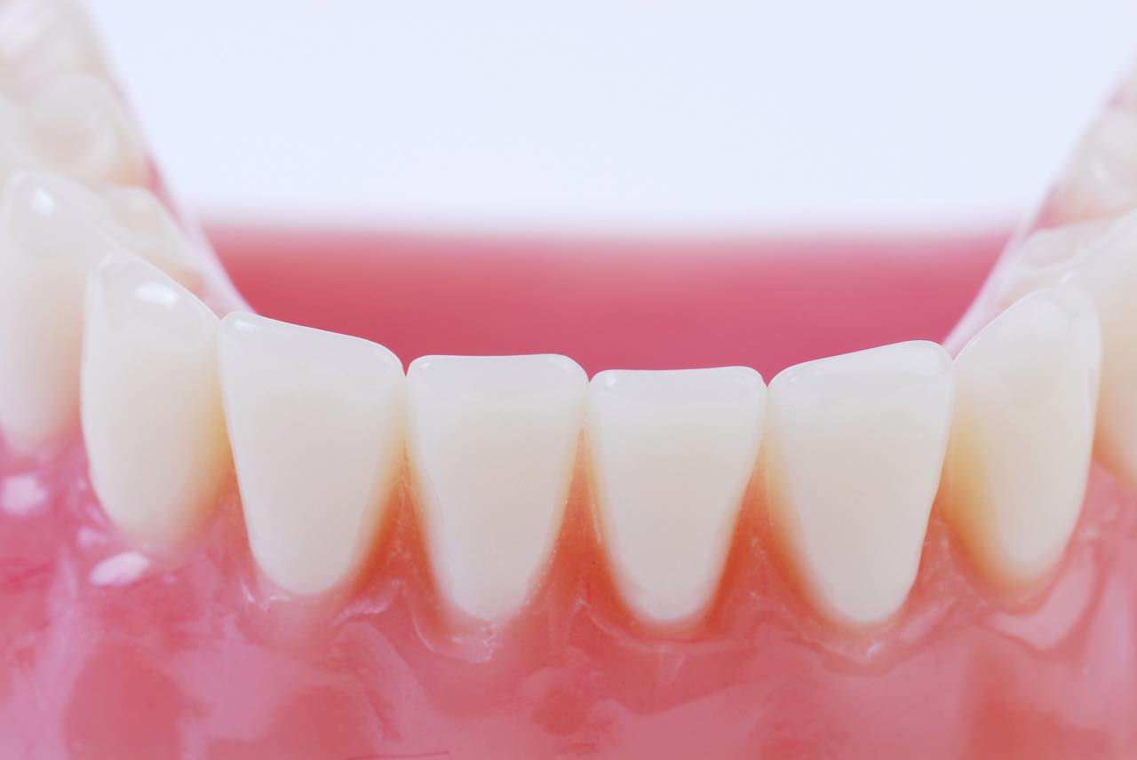 歯の矯正による歯肉退縮(歯茎が下がる)原因と対策