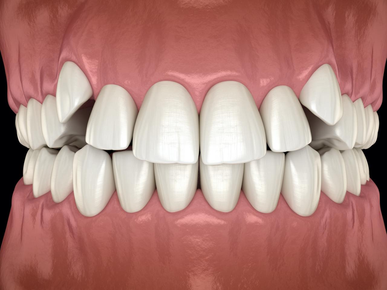 八重歯のインビザライン矯正のポイントと注意点