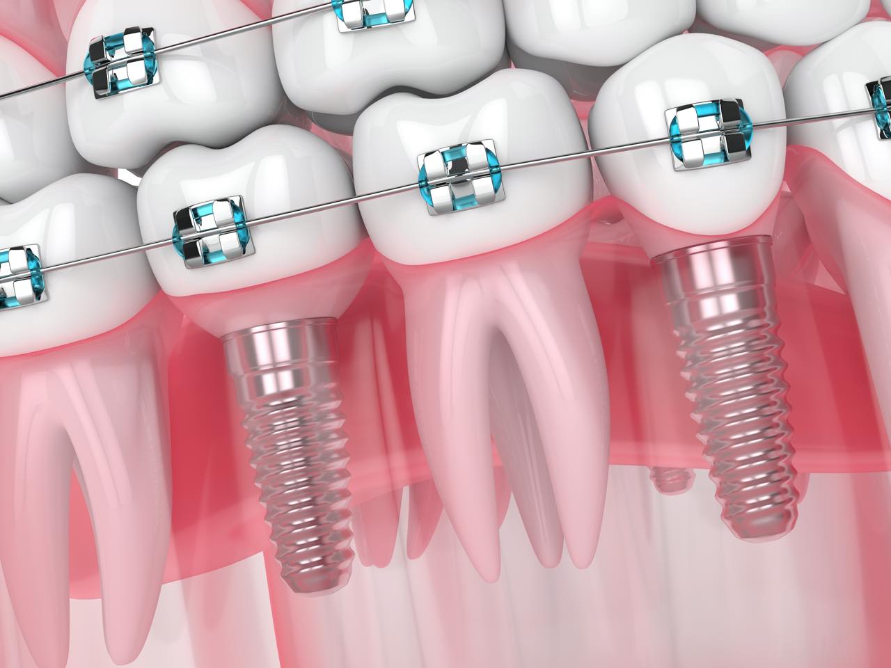 歯列矯正とインプラント治療の優先順序は？