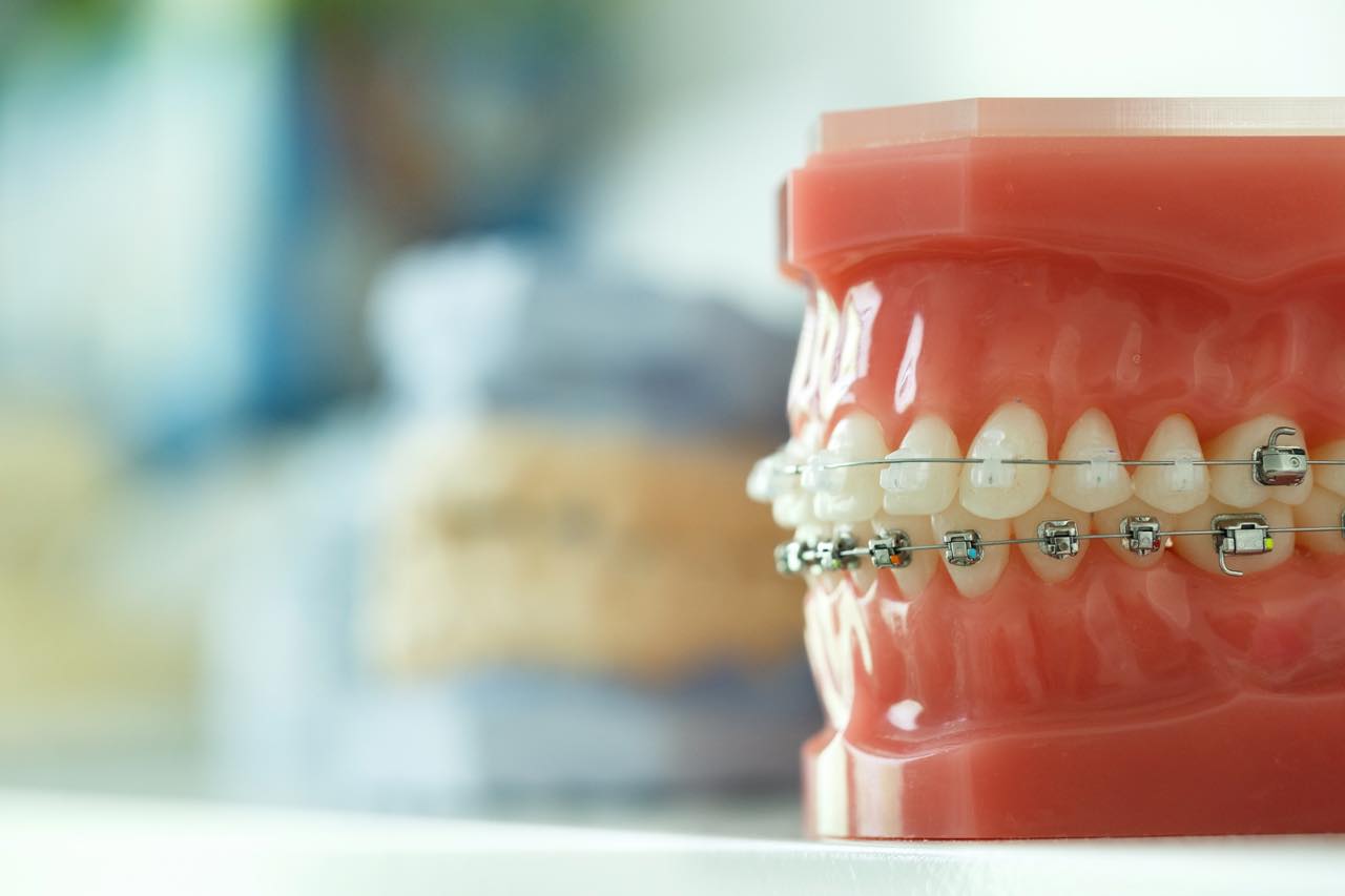 歯列矯正で歯の動きを早めるコルチコトミーとは？