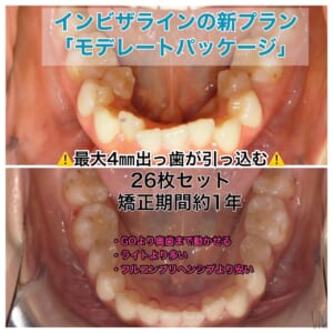 モニター インビザライン・モデレート