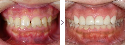 症例写真 セラミック矯正 治療本数：上前歯6本 すきっ歯、歯の着色