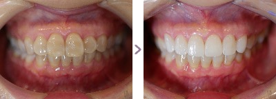 症例写真 セラミック矯正 上前歯6本 出っ歯、テトラサイクリン歯