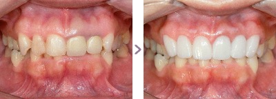 症例写真 セラミック矯正 上前歯6本 過蓋咬合、古い差し歯、メタルタトゥー、歯の着色、ガミースマイル