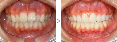 症例写真 セラミック矯正 上前歯8本 出っ歯、叢生