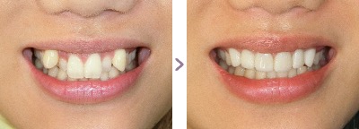 症例写真 セラミック矯正 上前歯6本 八重歯、叢生、出っ歯