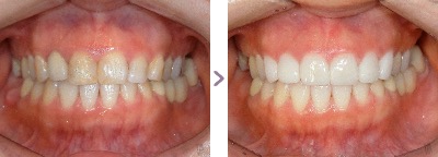 症例写真 セラミック矯正 上前歯6本 虫歯、古い差し歯、メタルタトゥー、歯の着色