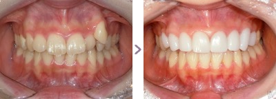 症例写真 セラミック矯正 上前歯8本 八重歯、叢生、歯の着色