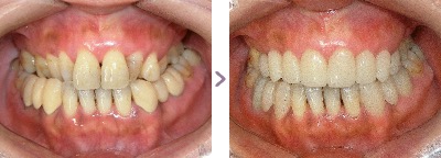 症例写真 セラミック矯正 上前歯8本、下前歯6本 受け口、咬合不全