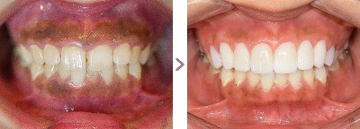 症例写真 セラミック矯正 治療本数：上前歯10本 歯が大きさ、歯の着色、ガミースマイル