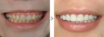 症例写真 歯肉整形、ラミネートベニア 歯の色・形態 治療本数：6本