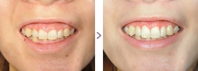症例写真 歯肉整形 ガミースマイル 治療本数：片顎4〜6本