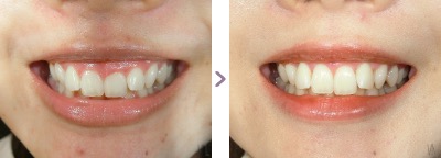 症例写真 歯肉整形 ガミースマイル 治療本数：片顎4〜6本