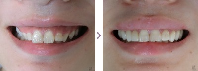 症例写真 歯肉整形、ラミネートベニア ガミースマイル、歯の形態 治療本数：片顎7〜10本