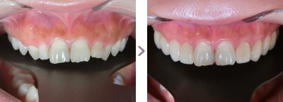 症例写真 ラミネートベニア、歯肉整形 歯の色・形態、ガミースマイル 治療本数：4本