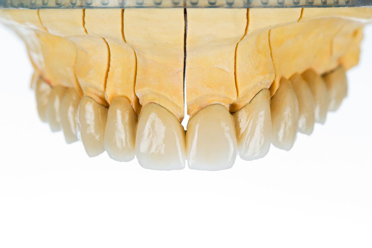セラミック矯正で出っ歯の歯並びは治せる？