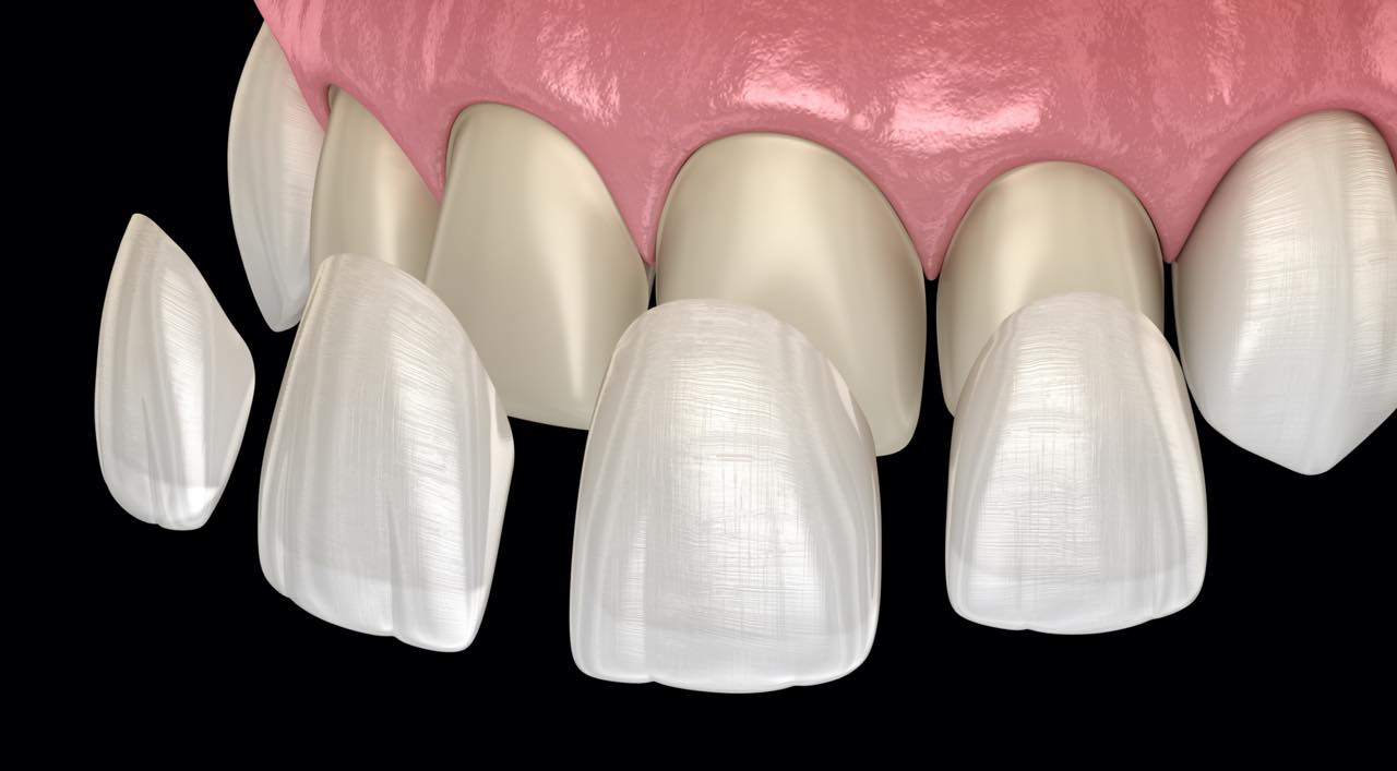 セラミック歯の治療で不自然にならないためのポイントとセラミックのやり直しの注意点